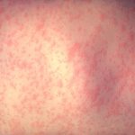 People in RQHR may have been exposed to measles