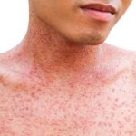 Measles case confirmed in Yorkton